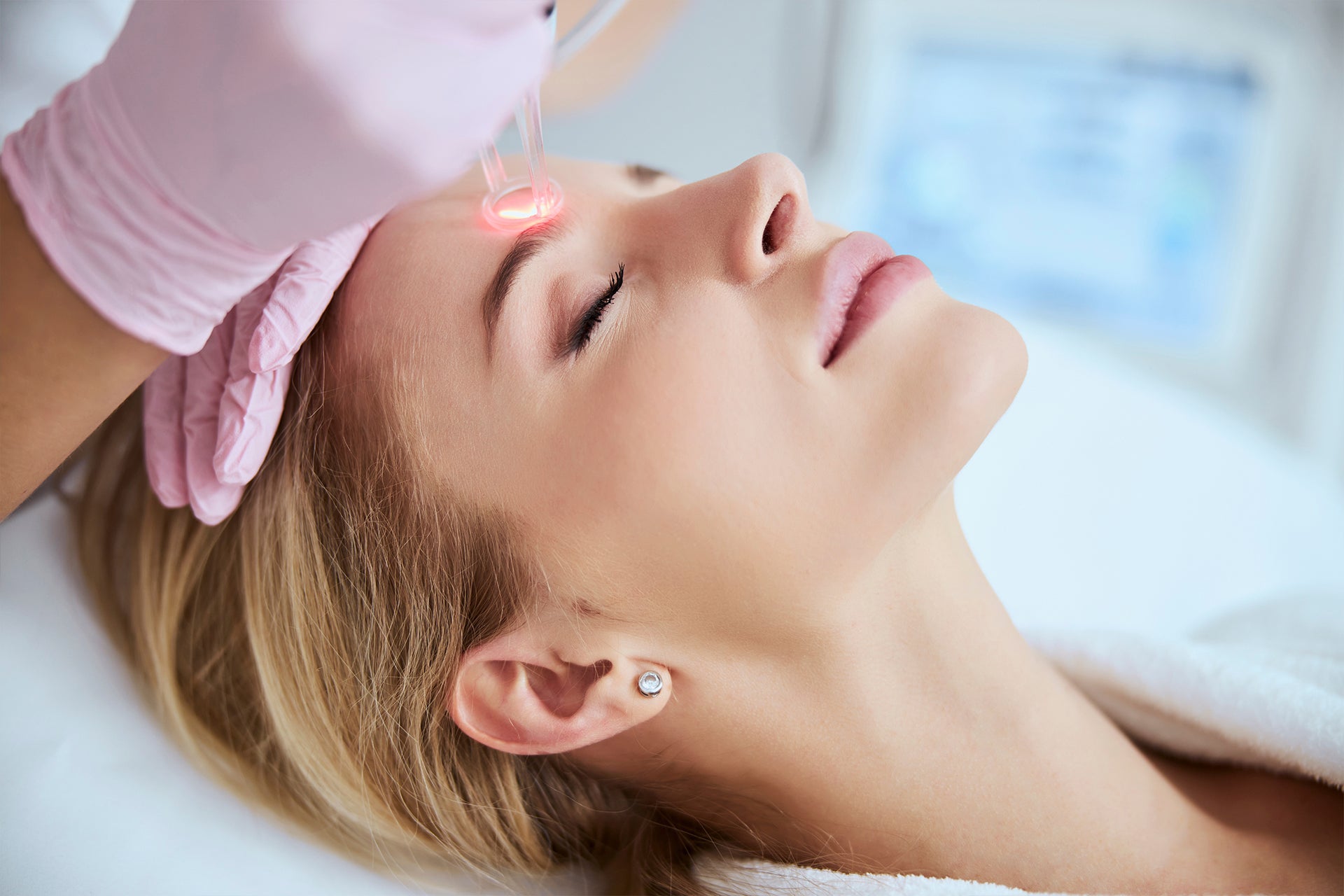Facial laser skin rejuvenation treatment performed by a licensed aesthetic provider using ResurFX





