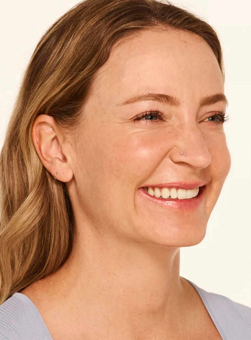 Before wrinkle relaxer treatment showing visible fine lines and facial wrinkles in St. Augustine, FL