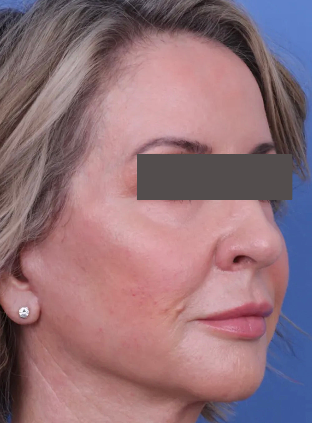 After CO2 laser resurfacing showing smoother skin, improved texture, and reduced fine lines in St. Augustine, FL
