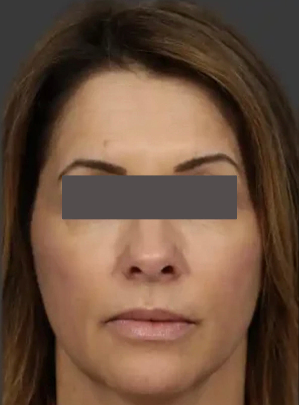 After CO2 laser resurfacing showing smoother skin, improved texture, and reduced fine lines in St. Augustine, FL