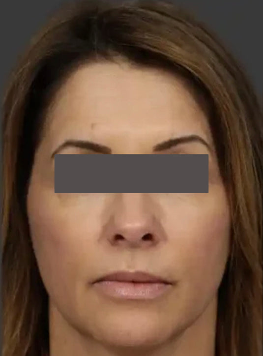 After CO2 laser resurfacing showing smoother skin, improved texture, and reduced fine lines in St. Augustine, FL