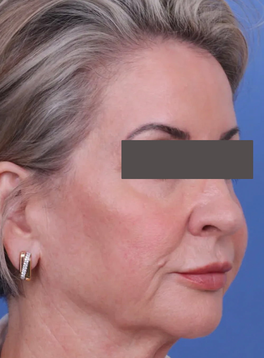 Before CO2 laser treatment showing uneven skin texture, fine lines, and sun damage in St. Augustine, FL