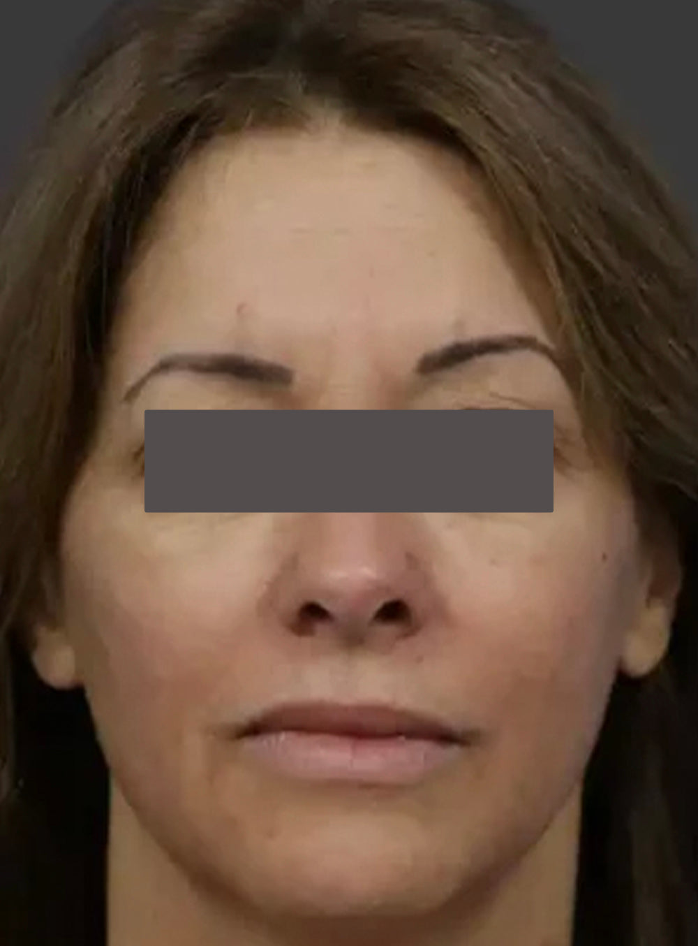 Before CO2 laser treatment showing uneven skin texture, fine lines, and sun damage in St. Augustine, FL