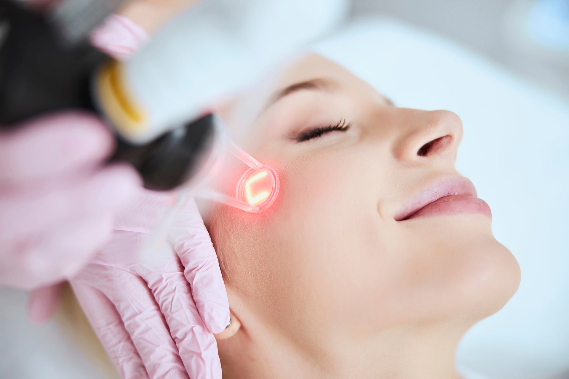 CO₂ Laser skin rejuvenation treatment performed on the face by a licensed aesthetic provider