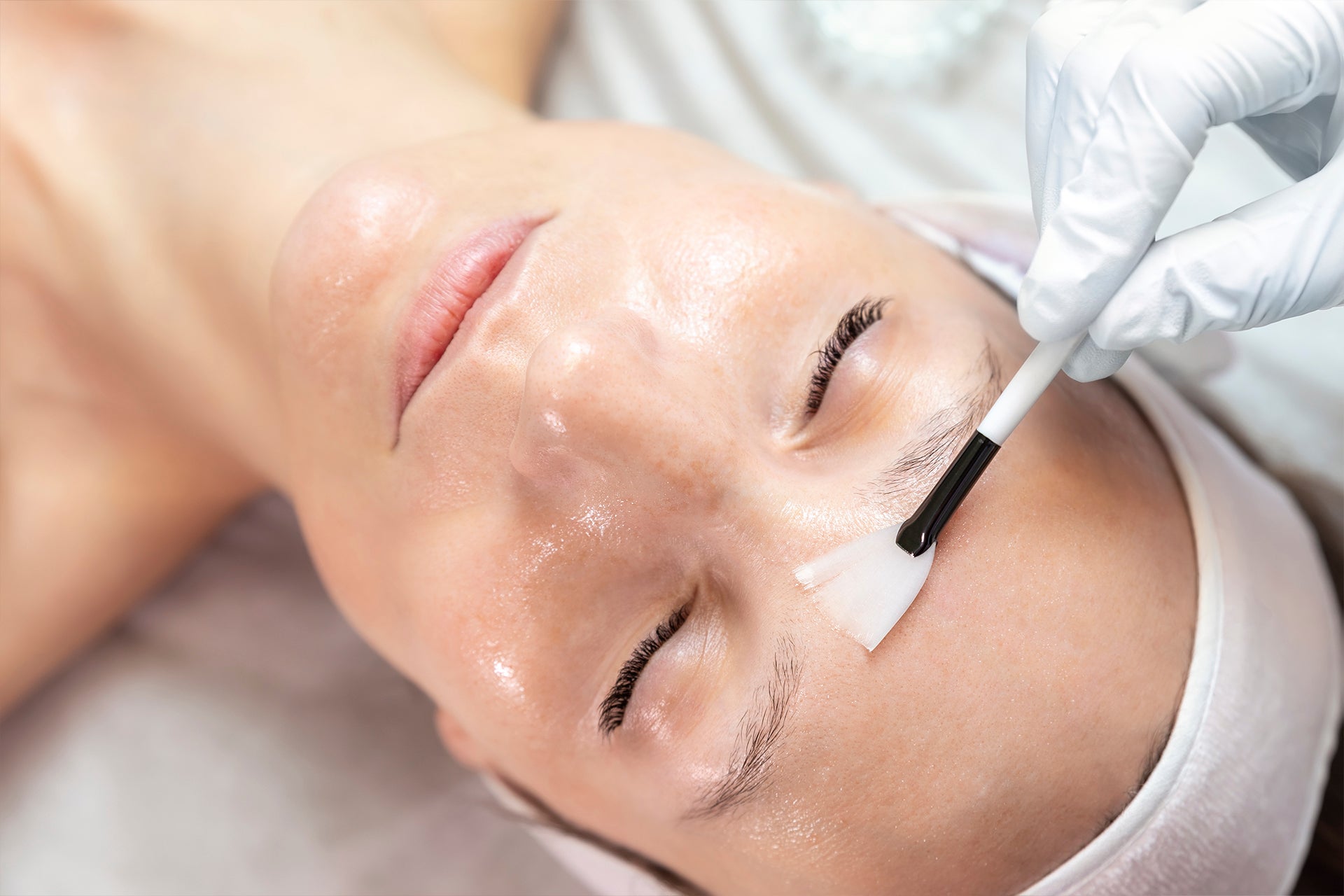 Chemical peel solution applied to the face by a licensed aesthetic provider





