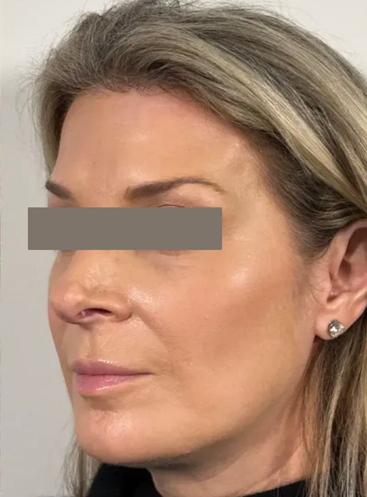 After Radiesse facial biostimulation treatment showing improved volume, firmness, and skin texture in St. Augustine, FL