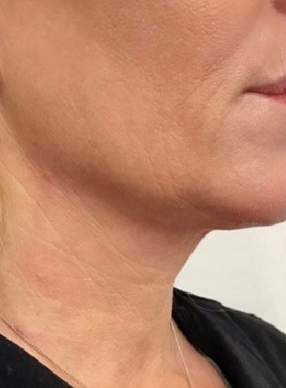 After Radiesse facial biostimulation treatment showing firmer, smoother neck skin and improved texture in St. Augustine, FL