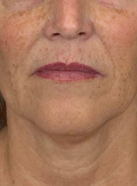 After Radiesse facial biostimulation treatment showing firmer, smoother neck skin and improved texture in St. Augustine, FL