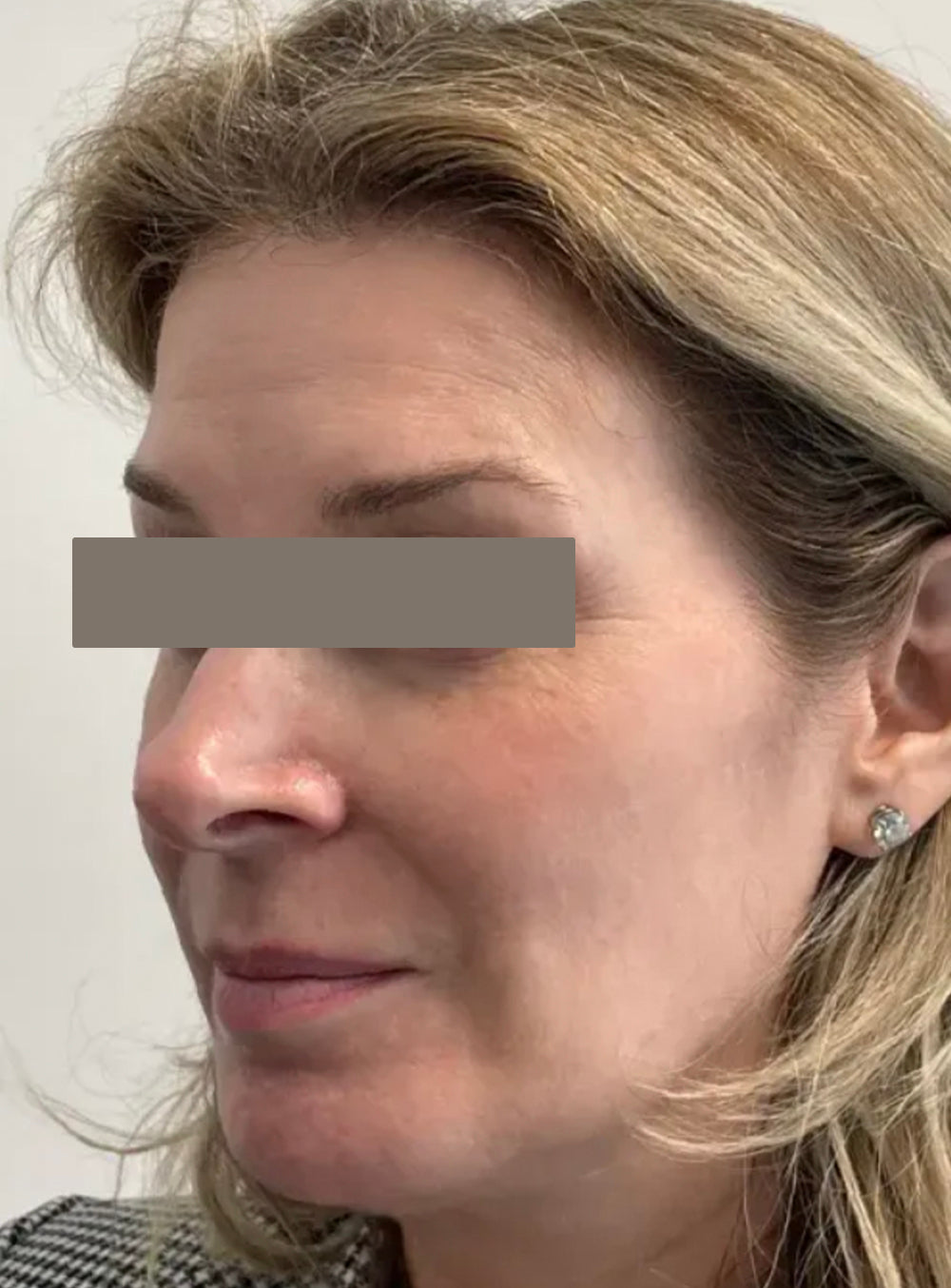 Before facial biostimulation treatment showing volume loss and skin laxity in St. Augustine, FL