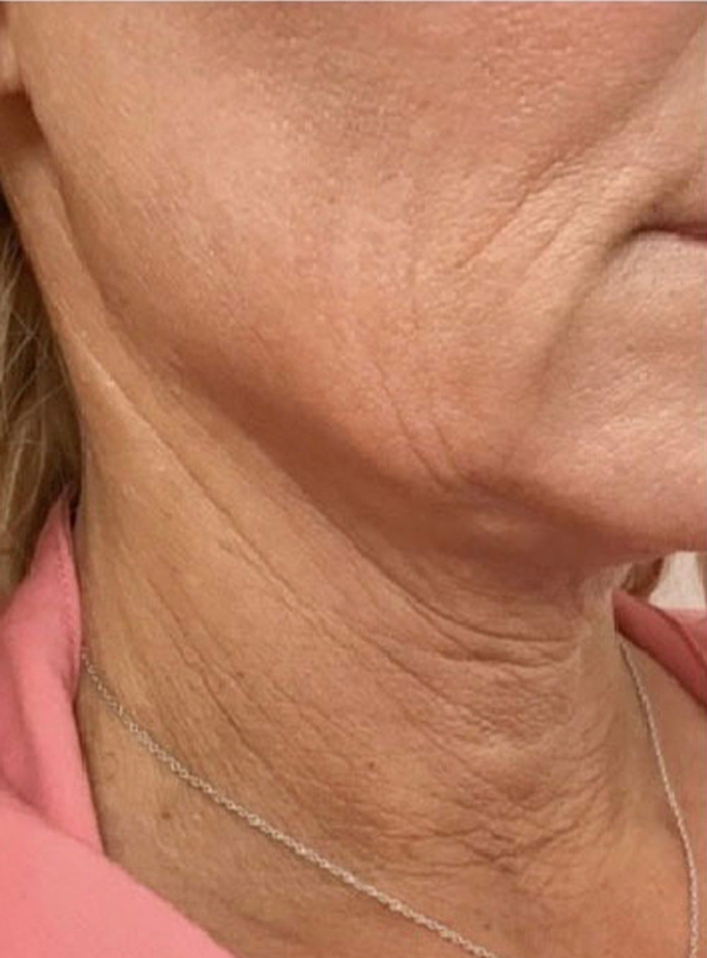Before facial biostimulation treatment showing neck skin laxity and fine lines in St. Augustine, FL