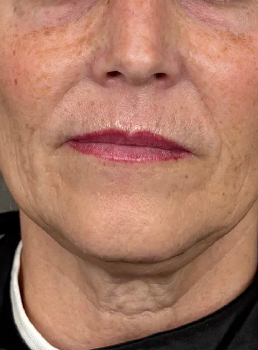 Before facial biostimulation treatment showing neck skin laxity and fine lines in St. Augustine, FL