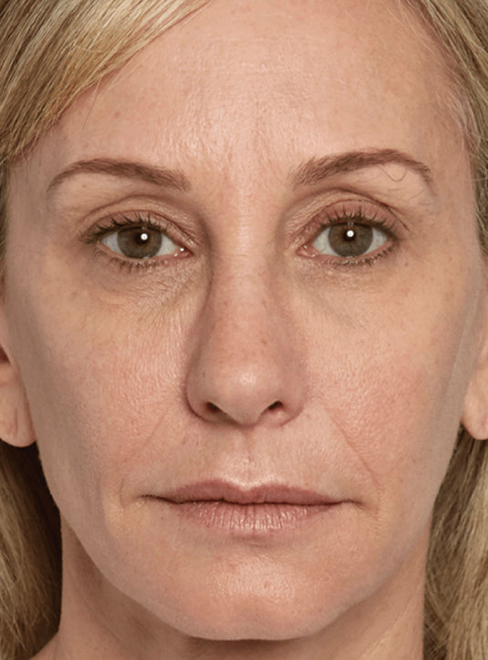 After Sculptra dermal filler treatment showing restored volume and smoother, youthful skin in St. Augustine, FL