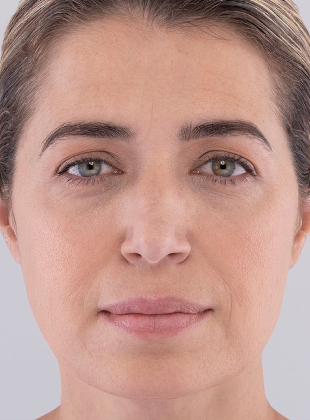 After Sculptra dermal filler treatment showing restored volume and smoother, youthful skin in St. Augustine, FL
