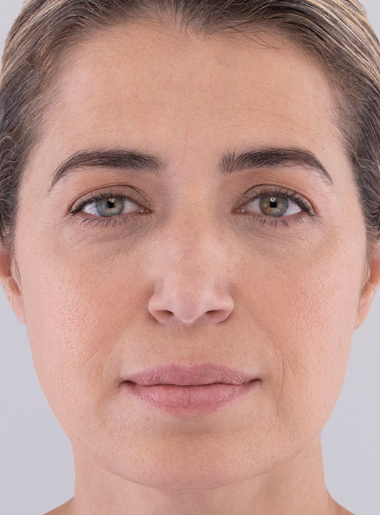 After Sculptra dermal filler treatment showing restored volume and smoother, youthful skin in St. Augustine, FL