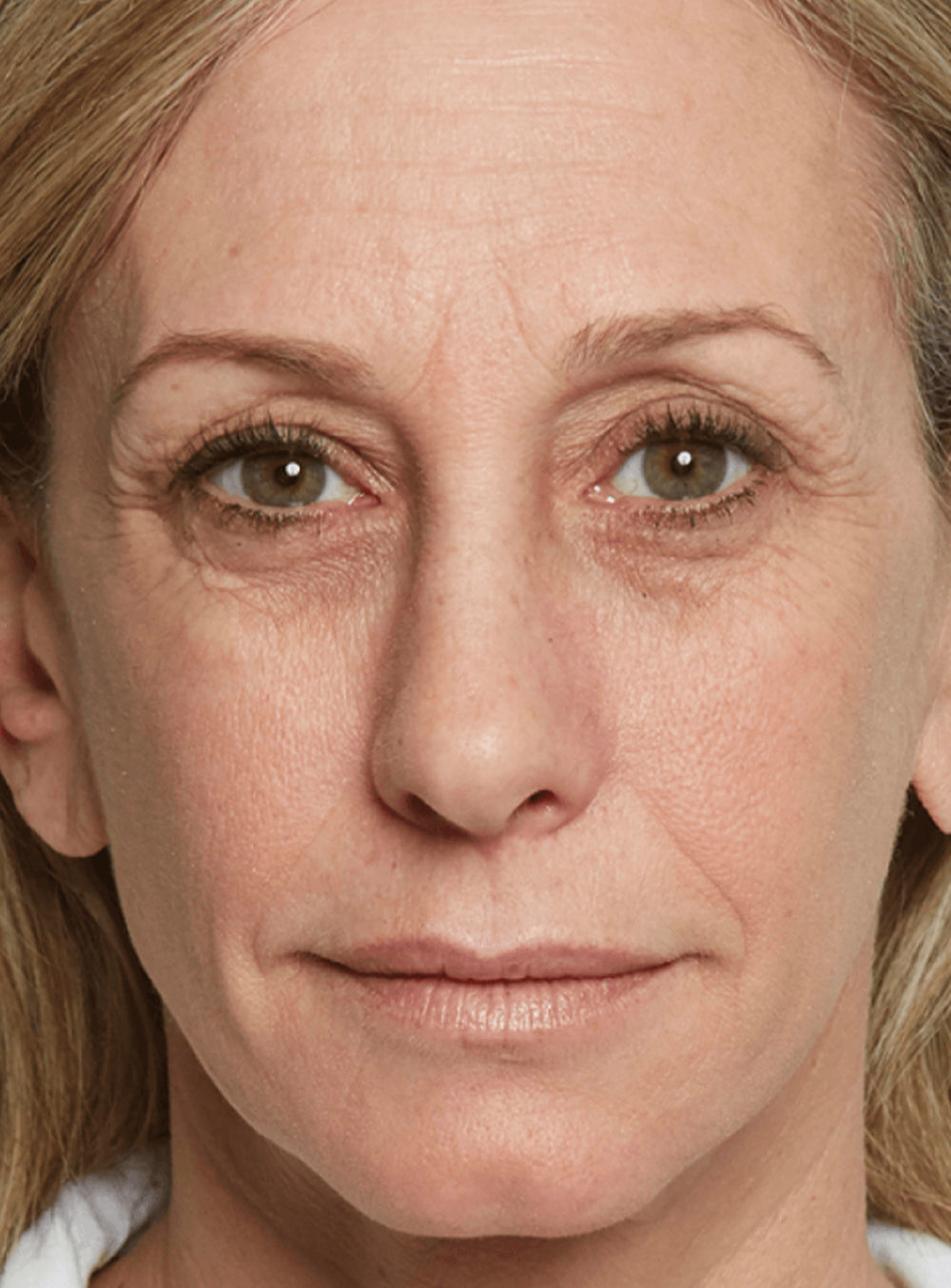 Before dermal filler treatment showing volume loss and facial lines in St. Augustine, FL