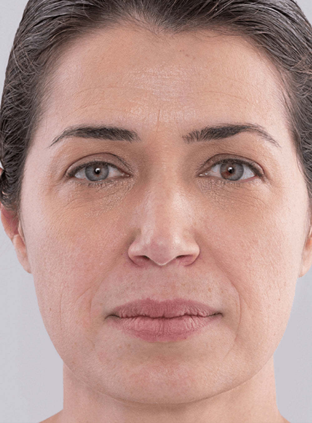 Before dermal filler treatment showing volume loss and facial lines in St. Augustine, FL