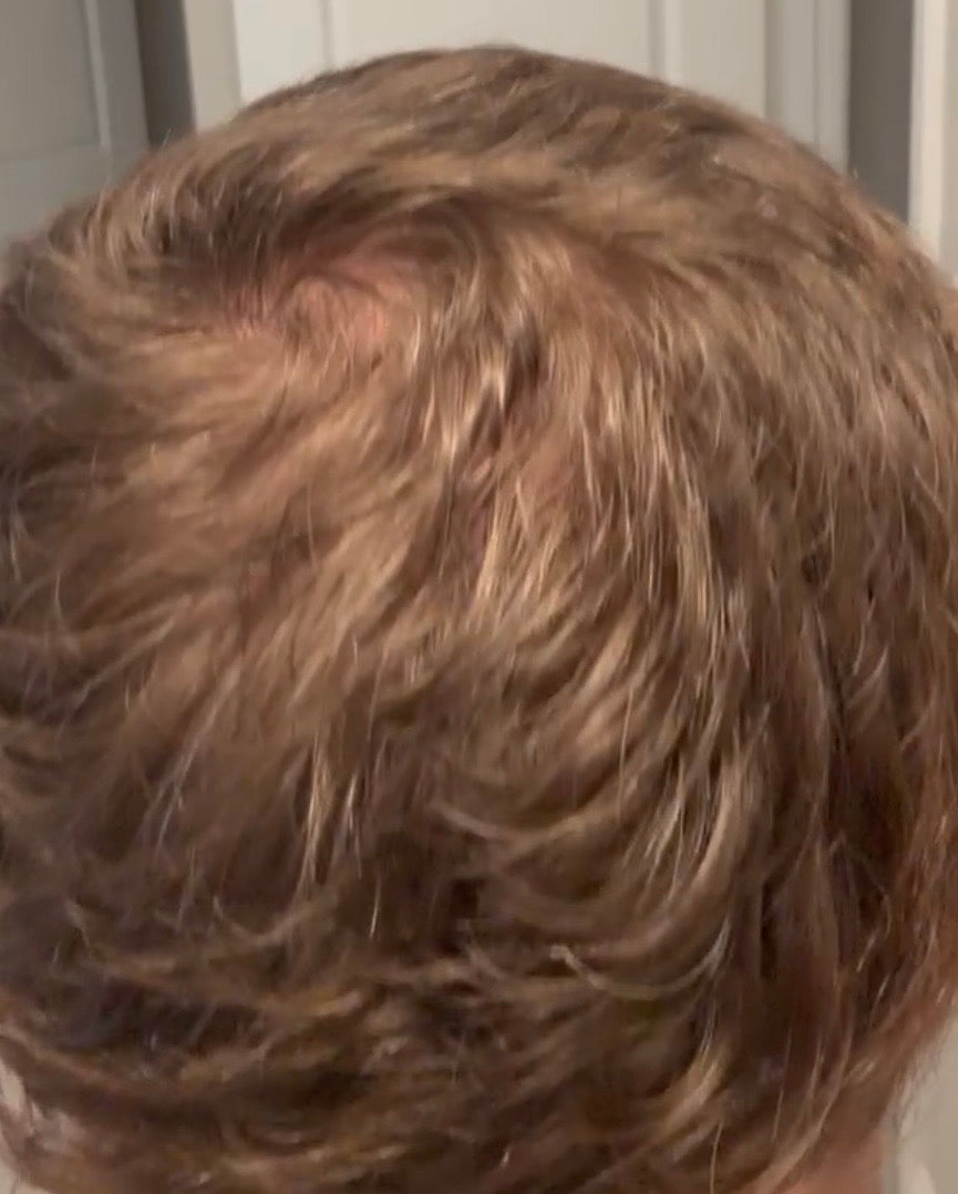 After HydraScalp Keravive and microneedling with PDGF showing improved hair density