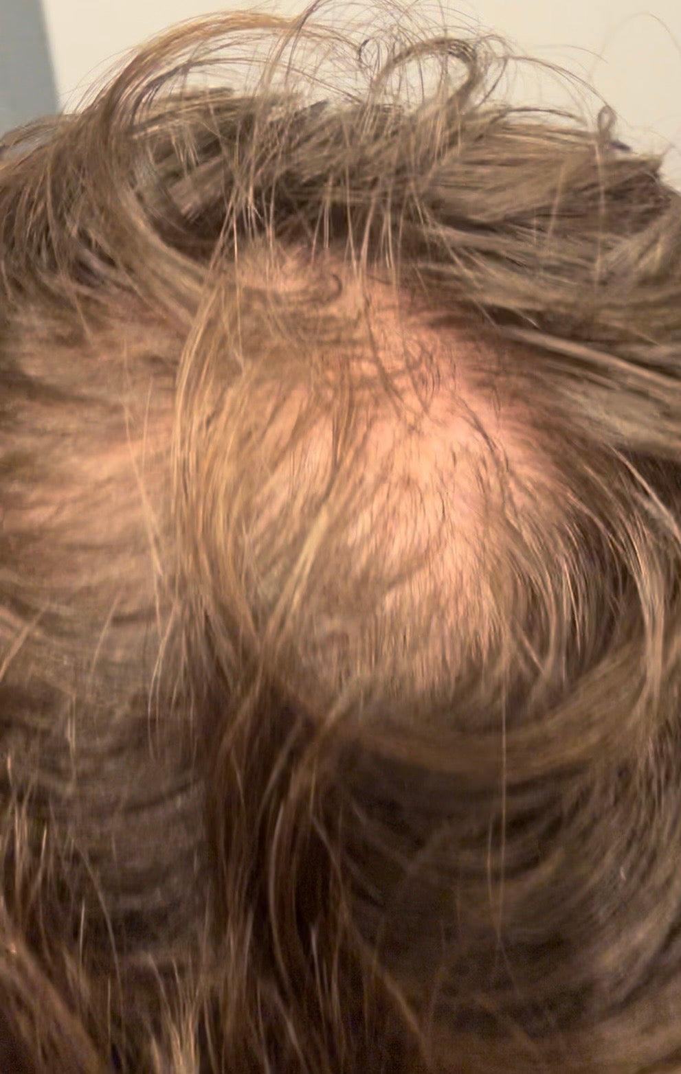 Before hair restoration showing thinning hair and scalp visibility