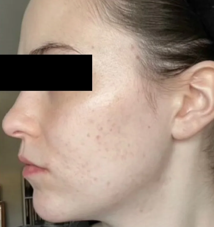 After Neova Professional Peel showing the side profile of the face with reduced appearance of acne, less redness, smoother texture, and a more even-looking complexion along the cheek and jawline.