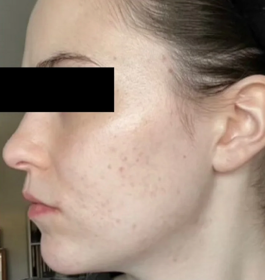 After Neova Professional Peel showing the side profile of the face with reduced appearance of acne, less redness, smoother texture, and a more even-looking complexion along the cheek and jawline.