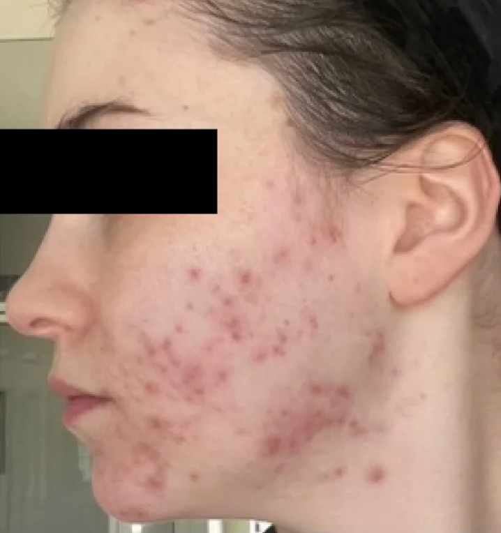 Before Neova Professional Peel showing the side profile of the face with active acne breakouts, redness, post-inflammatory marks, and uneven skin texture along the cheek and jawline.