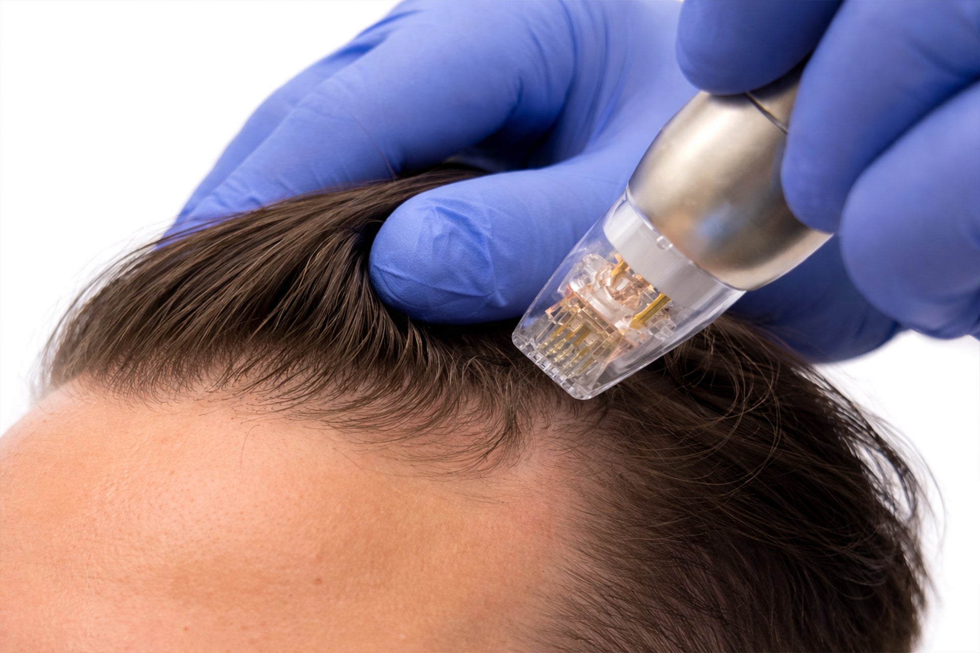 PDGF with microneedling hair restoration therapy stimulating scalp and promoting hair growth