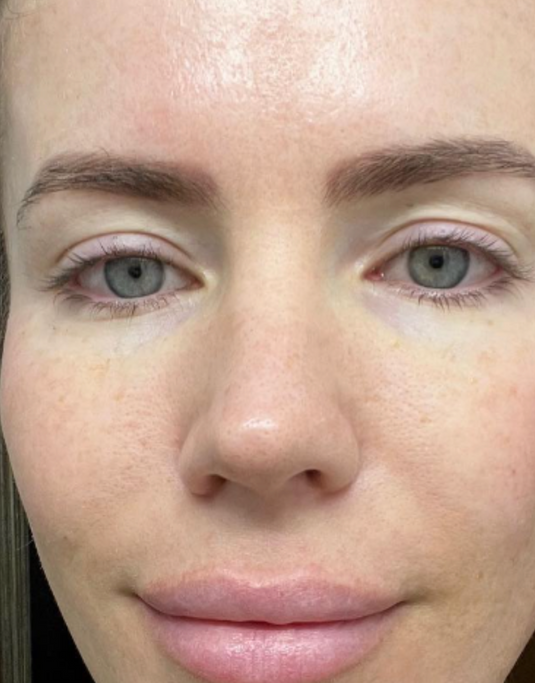 After PRX Derm Perfexion treatment showing the front view of the face with improved skin tone, smoother texture, refined pores, and a more even-looking complexion.