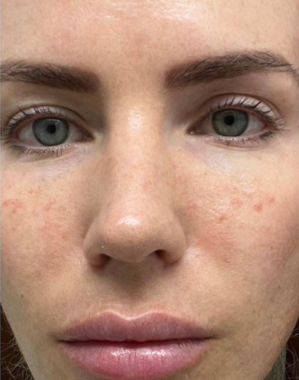 Before PRX Derm Perfexion treatment showing the front view of the face with uneven skin tone, visible pores, mild redness, and textured skin around the cheeks and nose.