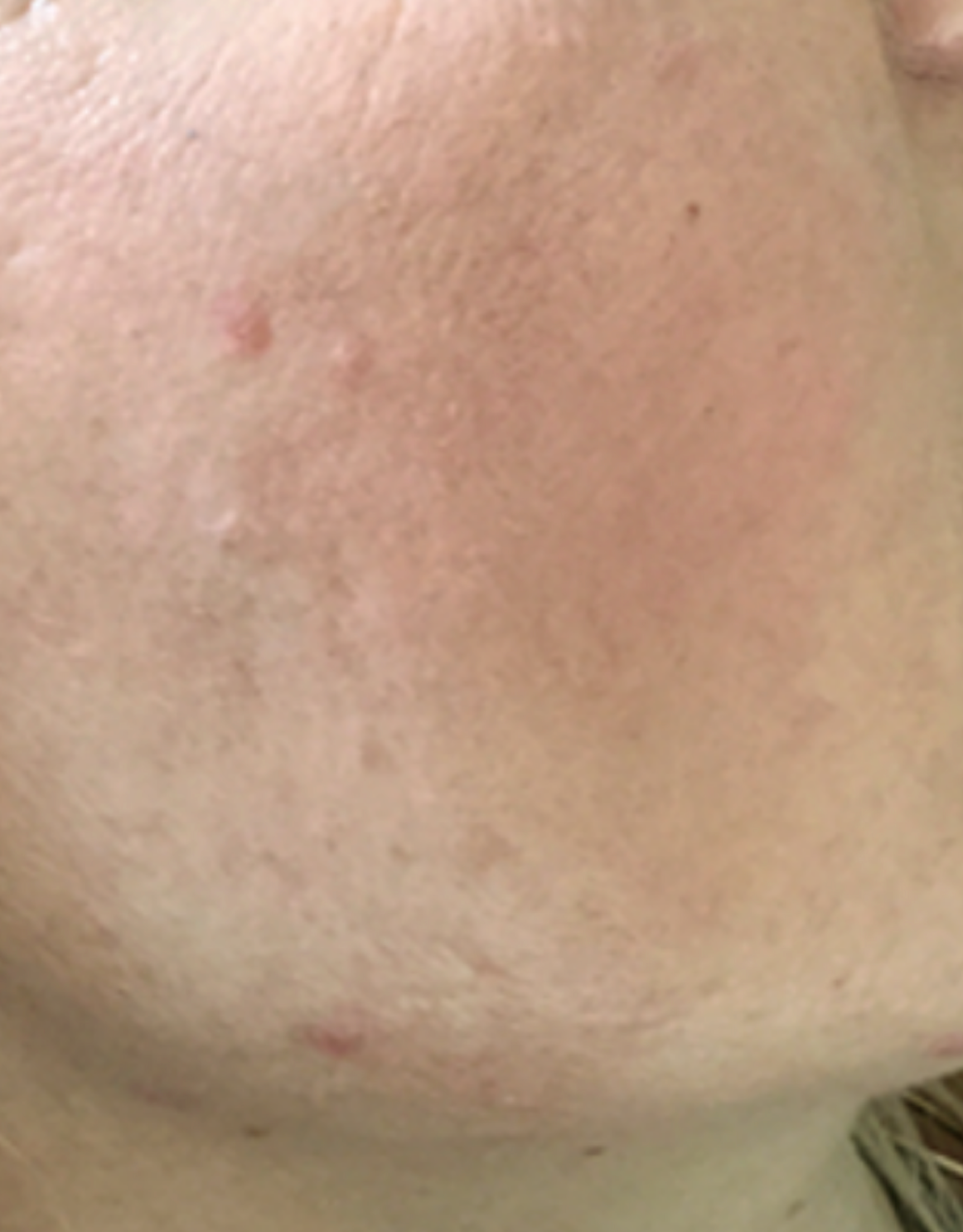 After PRX Derm Perfexion treatment showing a close-up of the cheek area with smoother texture, improved skin tone, refined pores, and reduced appearance of redness.