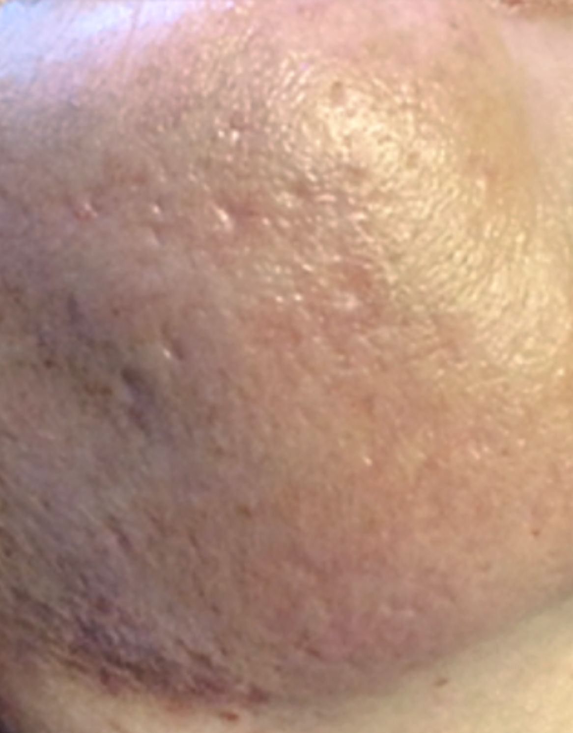 Before PRX Derm Perfexion treatment showing a close-up of the cheek area with uneven skin texture, visible pores, mild redness, and small blemishes.