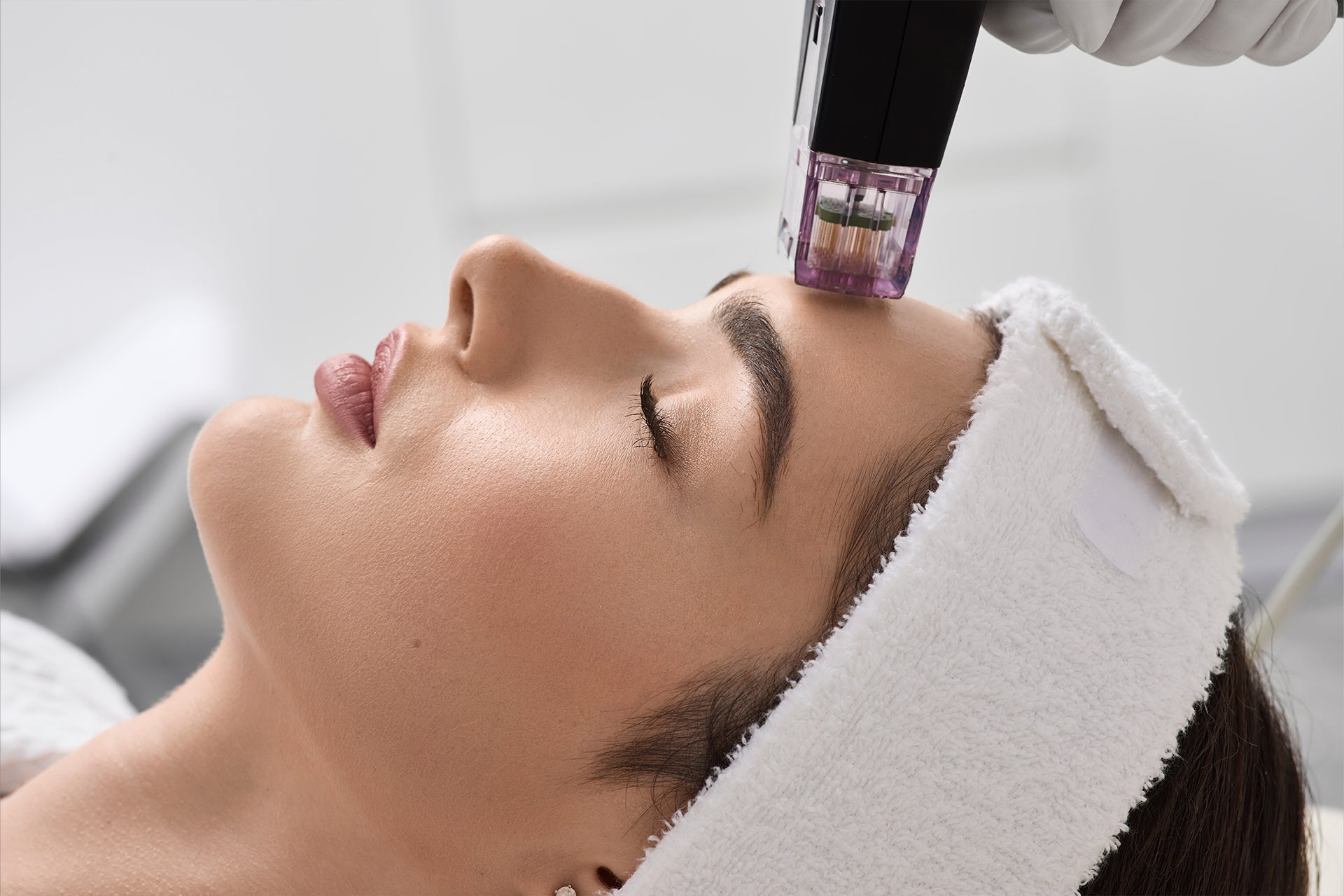 RF microneedling treatment performed on the face by a licensed aesthetic provider





