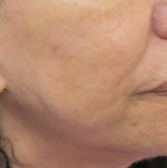 After ResurFX treatment showing a close-up of the cheek and jawline area with smoother skin texture, improved tone, refined pores, and a more even-looking complexion.