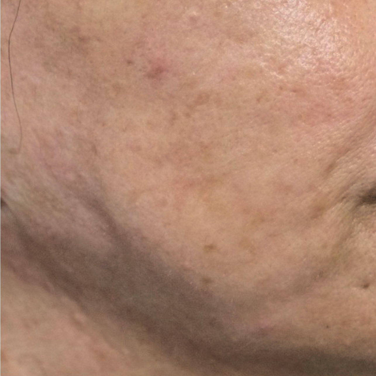 Before ResurFX treatment showing a close-up of the cheek and jawline area with uneven skin texture, visible pores, mild redness, and irregular skin tone.