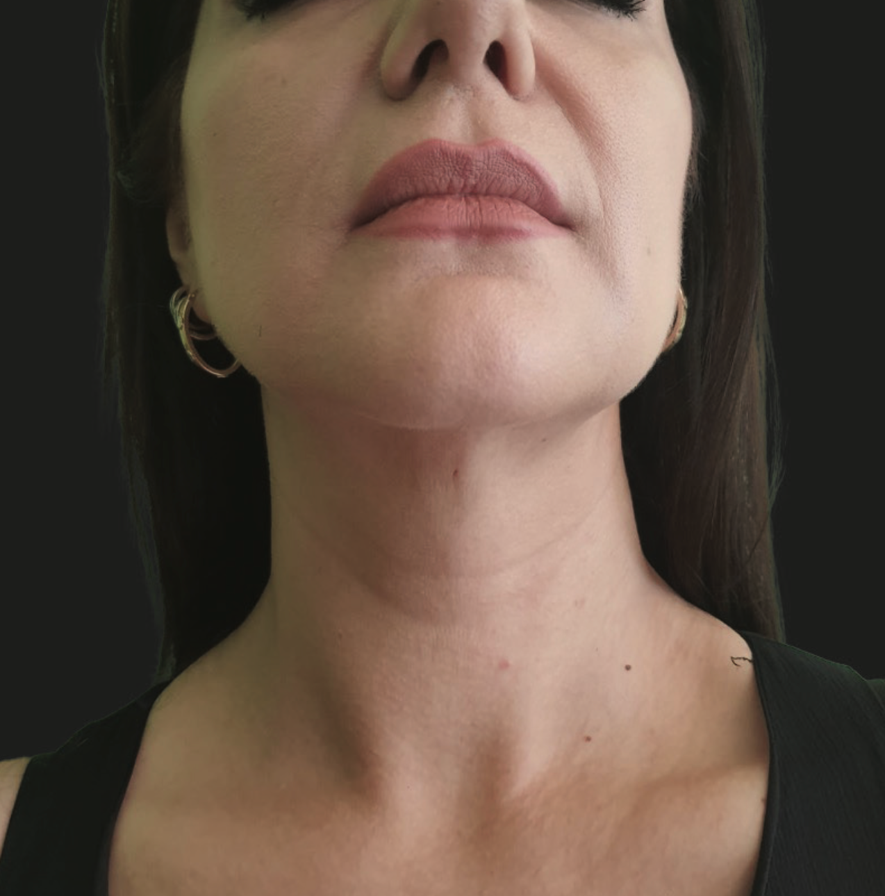 After ResurFX treatment showing the neck and lower face with smoother skin texture, improved tone, and reduced appearance of fine lines and crepey skin.