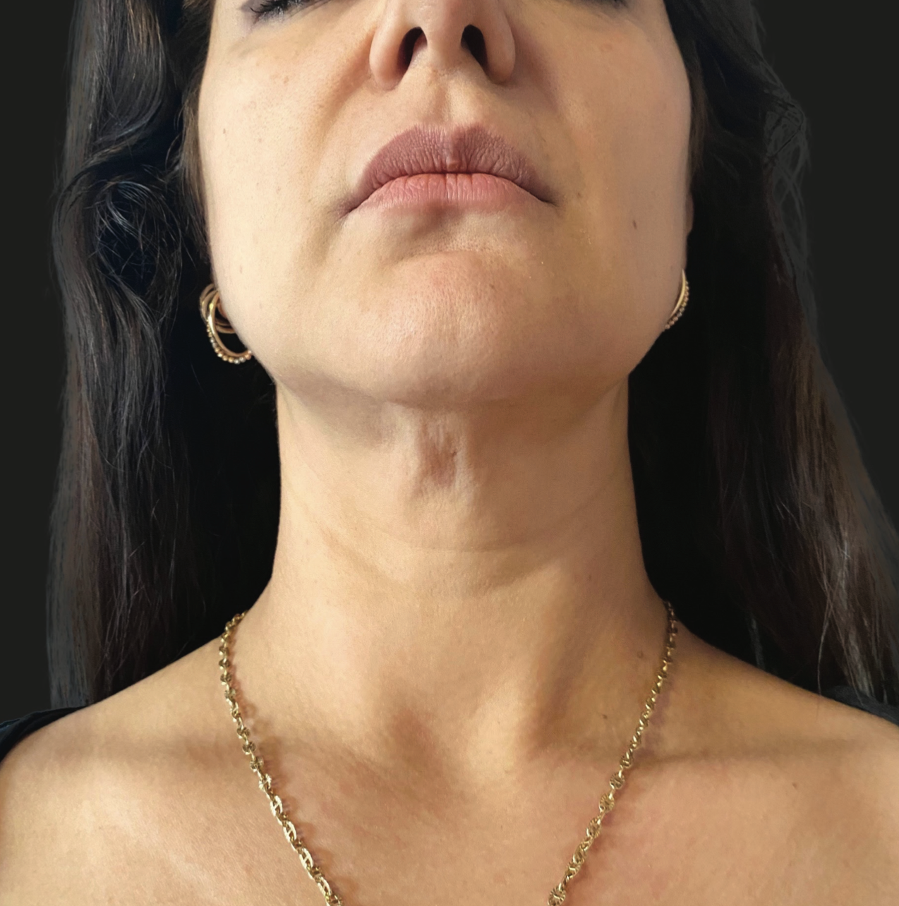 Before ResurFX treatment showing the neck and lower face with visible skin laxity, uneven texture, fine lines, and crepey appearance in the neck area.