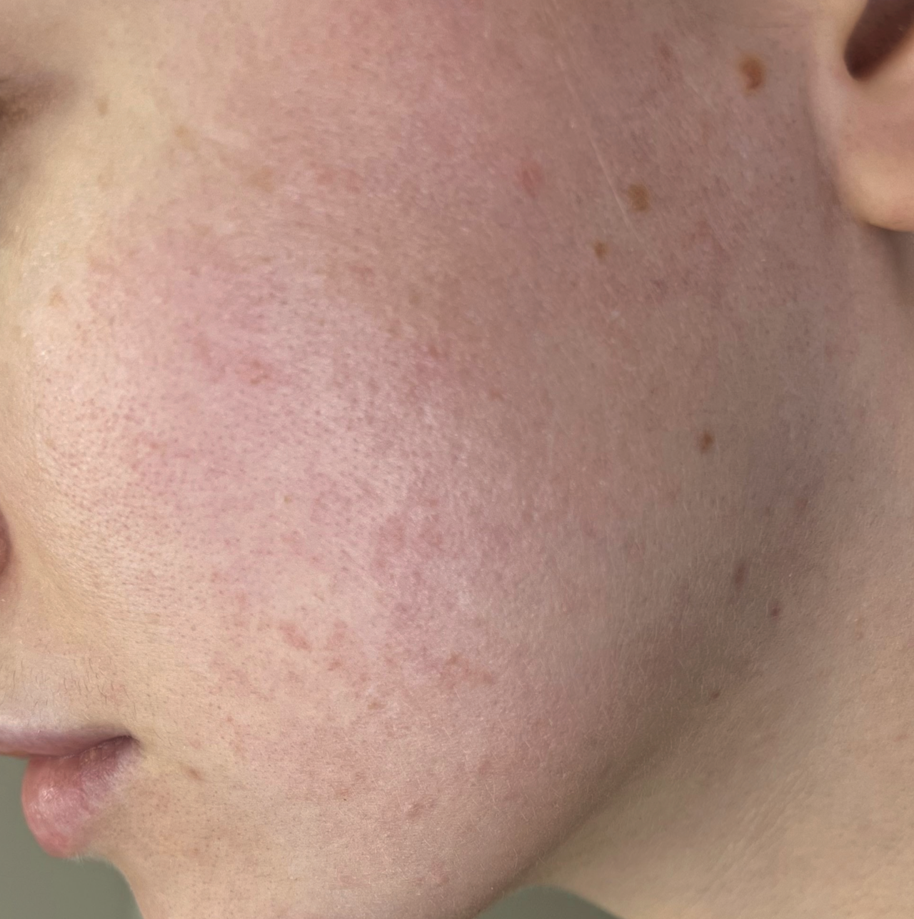 After ResurFX treatment showing a close-up of the cheek with smoother skin texture, reduced appearance of acne scarring, improved skin tone, refined pores, and a more even-looking complexion.