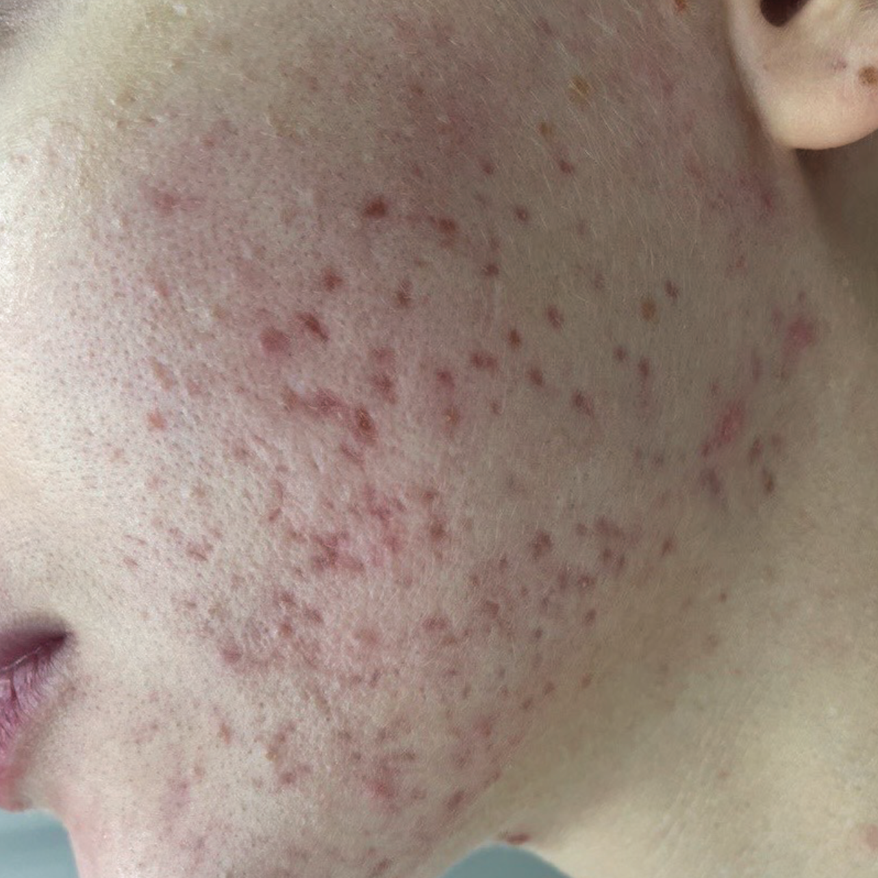 Before ResurFX treatment showing a close-up of the cheek with visible acne scarring, redness, textural irregularities, enlarged pores, and uneven skin tone.