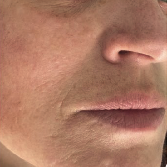 After XPL treatment showing the cheek, nose, and lip area with improved skin tone, smoother texture, and reduced appearance of pigmentation.