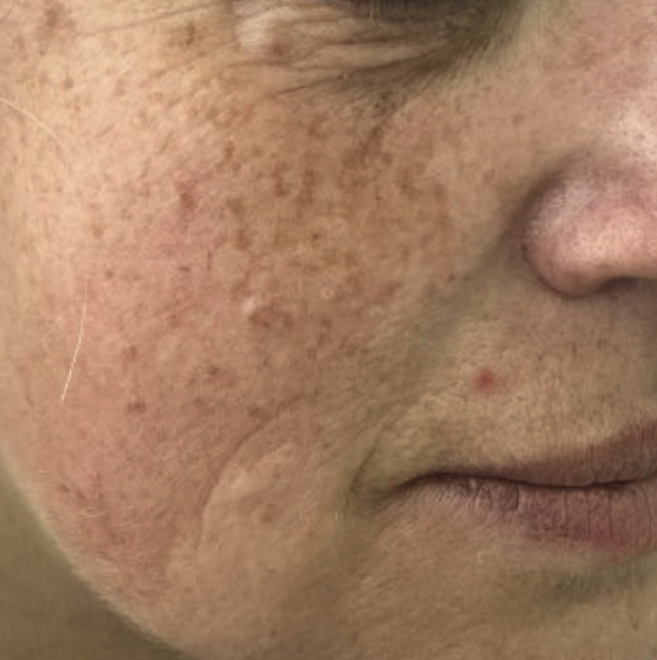 Before XPL treatment showing the cheek, nose, and lip area with visible sun damage, uneven pigmentation, fine lines, and textured skin.