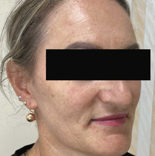 After XPL treatment showing the side profile of the face with improved skin tone, reduced appearance of sun damage and pigmentation, smoother texture, and a more even complexion.
