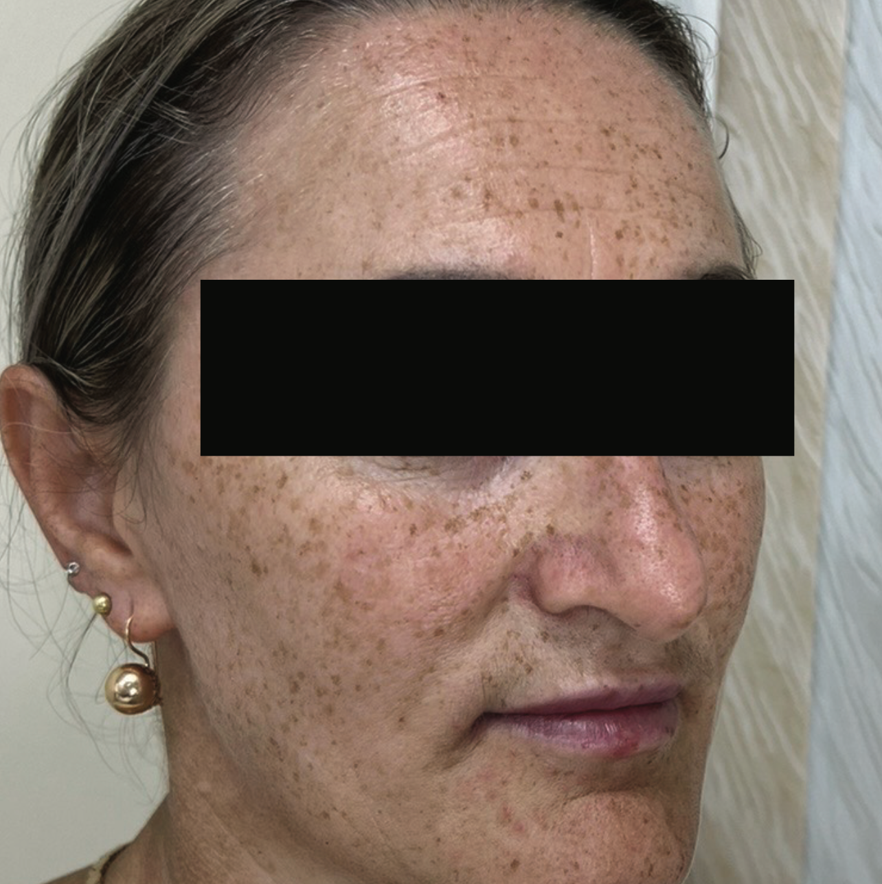 Before XPL treatment showing the side profile of the face with visible sun damage, freckles, uneven pigmentation, redness, and textured skin on the cheek and forehead.