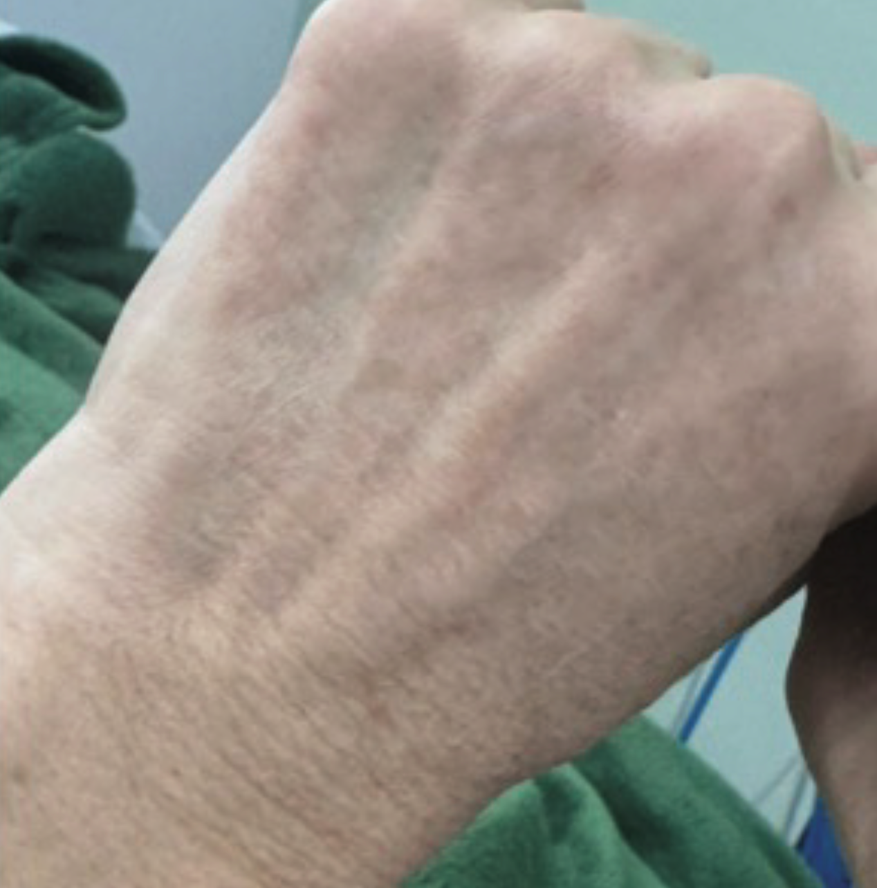 After XPL hand treatment showing the back of the hand with improved skin tone, reduced appearance of pigmentation, smoother texture, and more even-looking skin.
