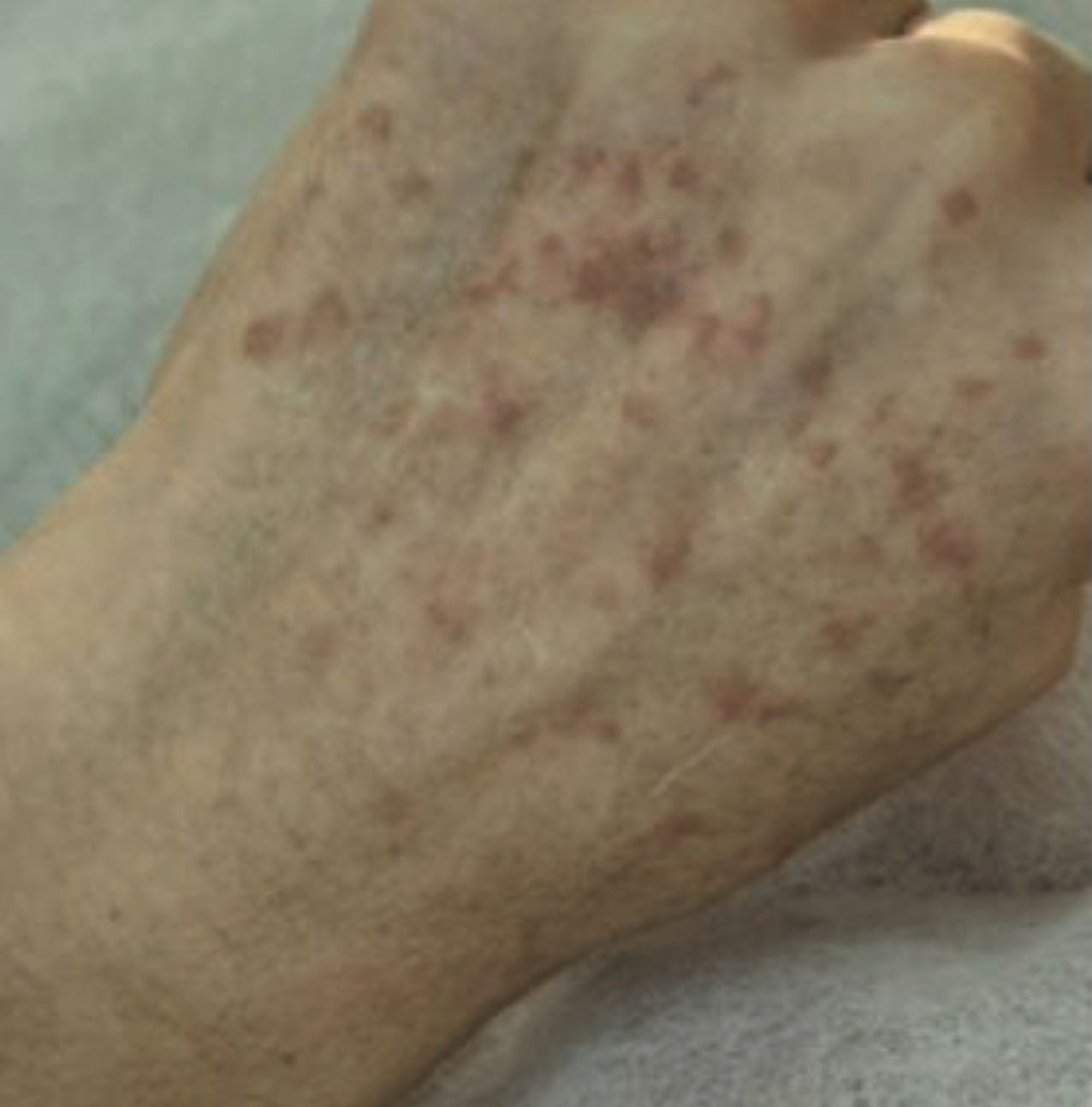 Before XPL hand treatment showing the back of the hand with visible sun damage, pigmentation spots, uneven skin tone, and textured skin.
