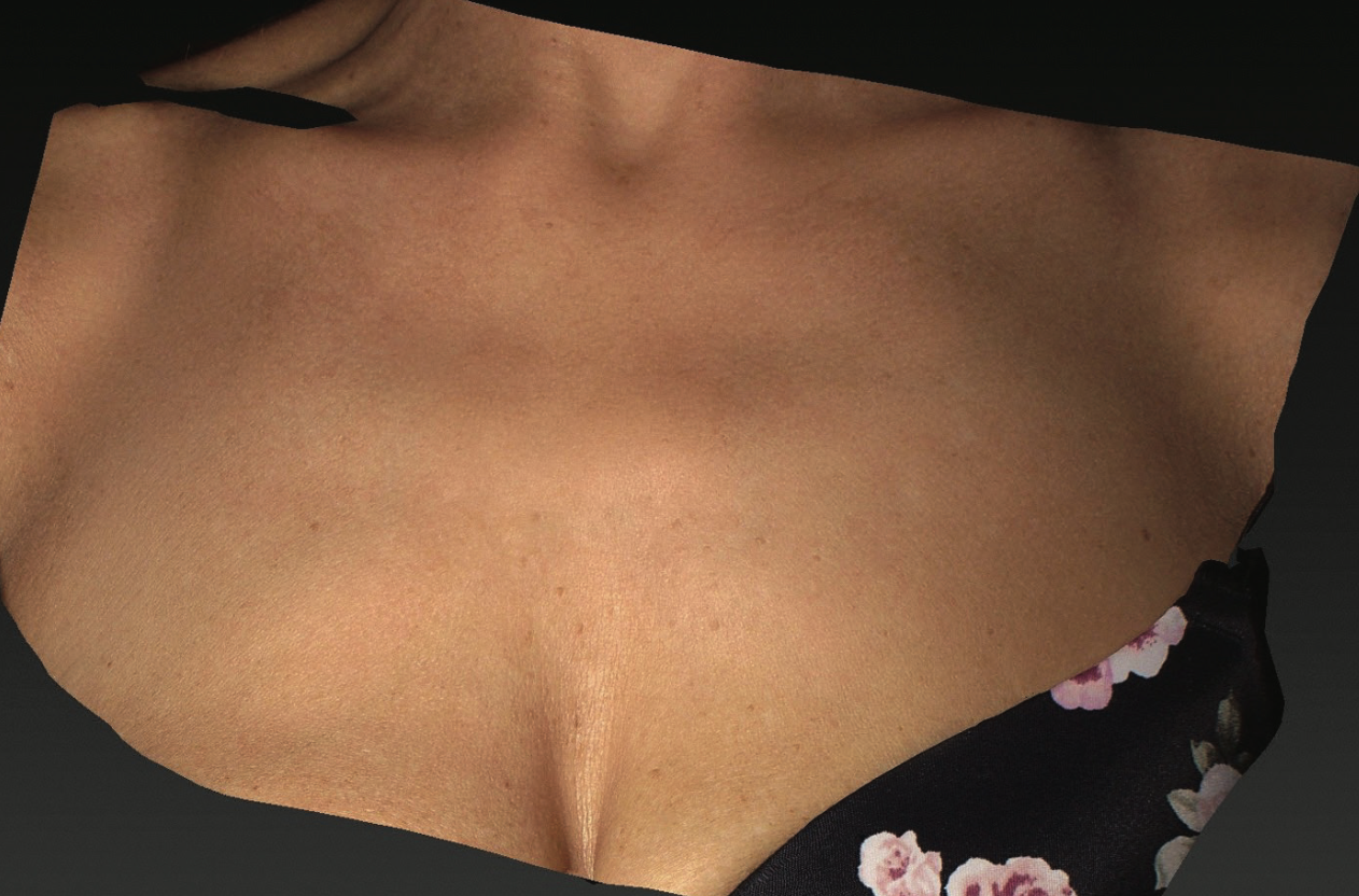 After XPL treatment showing the chest area with improved skin tone, reduced appearance of pigmentation, smoother texture, and a more even-looking décolletage.