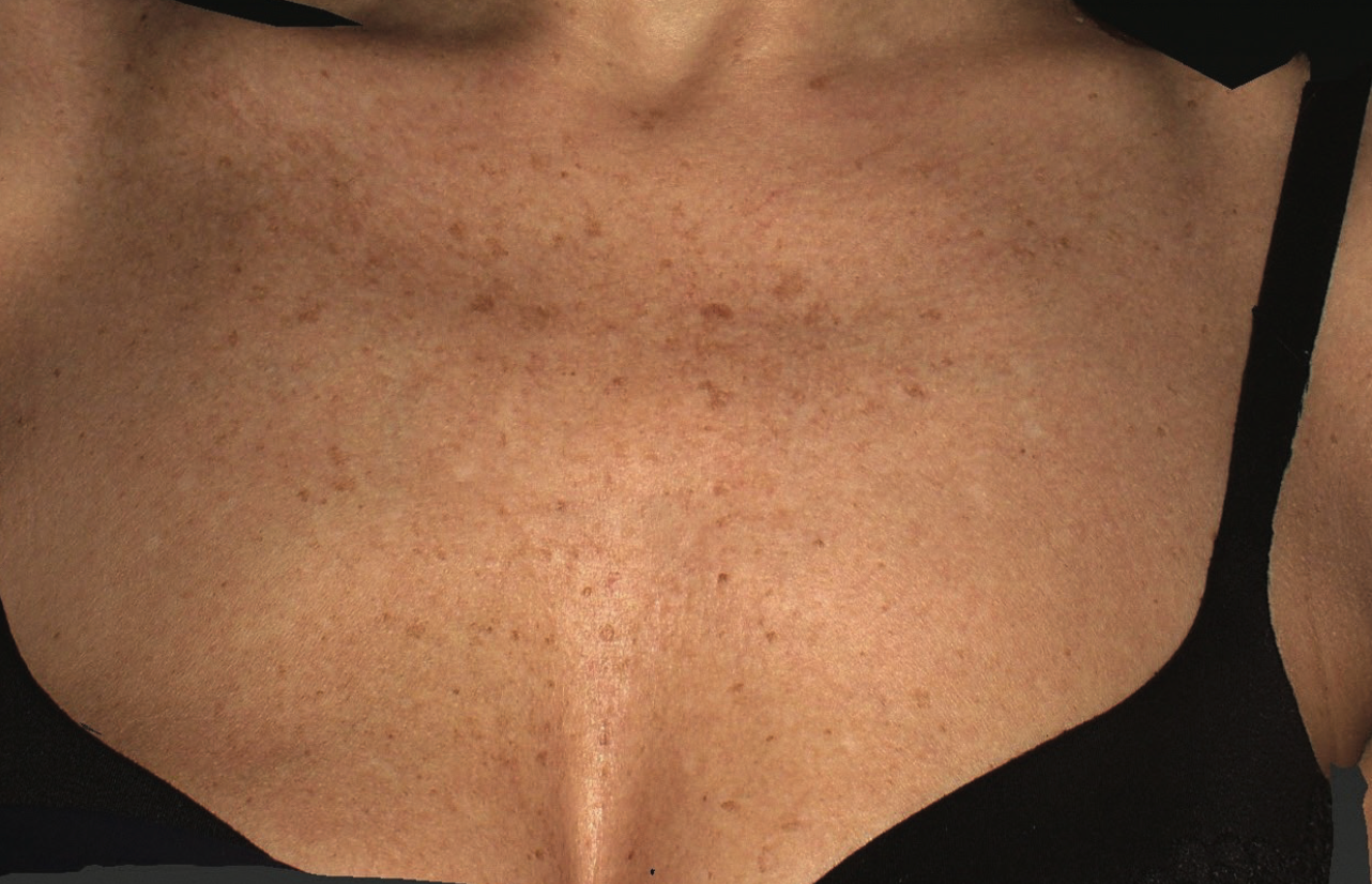 Before XPL treatment showing the chest area with visible sun damage, scattered pigmentation, uneven skin tone, and textured skin across the décolletage.