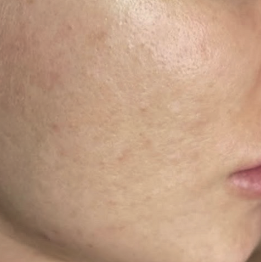 After XPL treatment showing smoother skin and improved tone on the cheek and jawline.
