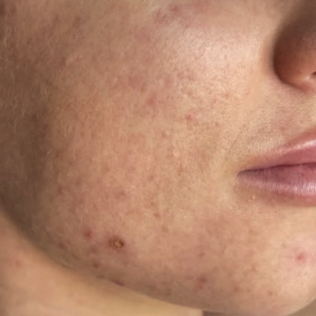 Before XPL treatment showing uneven texture and pigmentation on the cheek and jawline.