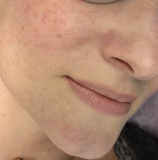 After XPL treatment showing a close-up of the cheek and lower face with improved skin tone, reduced appearance of redness, smoother texture, and a more even-looking complexion.