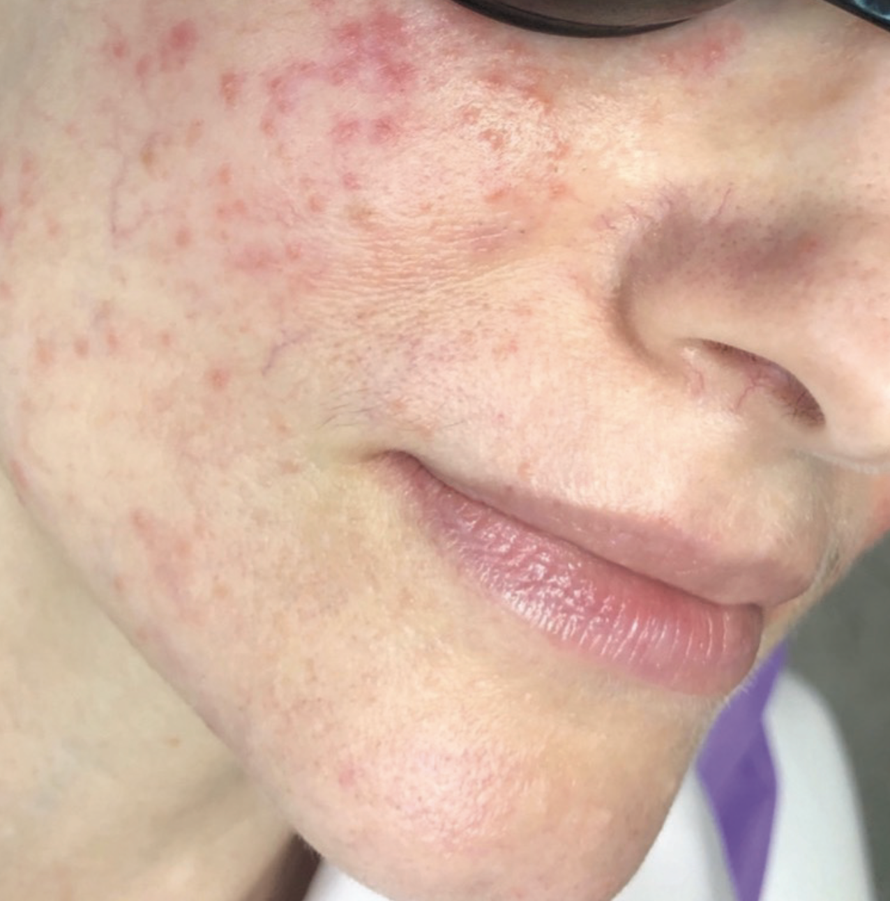 Before XPL treatment showing a close-up of the cheek and lower face with visible redness, uneven skin tone, textural irregularities, and scattered pigmentation.