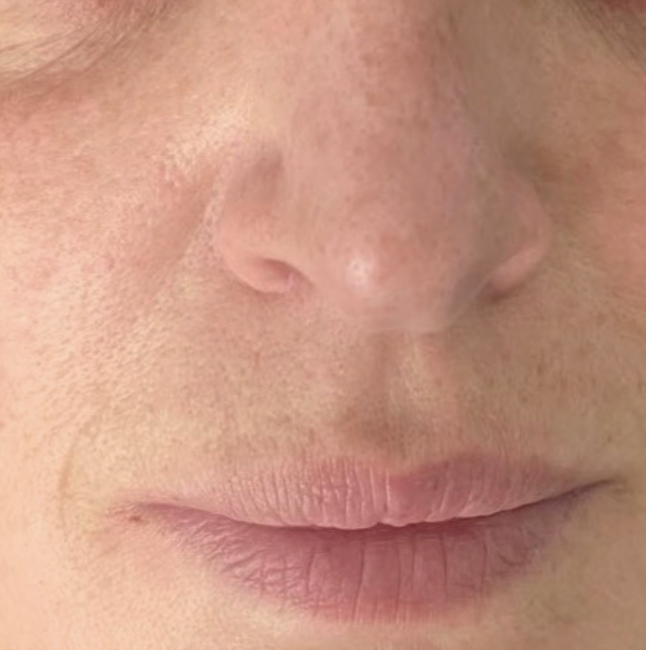 After XPL treatment showing the nose and lip area with improved skin tone, reduced redness, smoother texture, and a more even complexion.